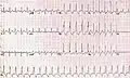 RBBB with associated tachycardia