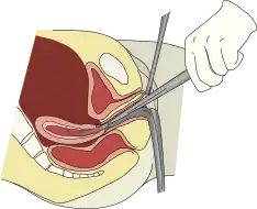 Dilation and curettage is performed to remove the firmly attached placental fragments, for the restoration of declined progesterone level to initiate lactation.