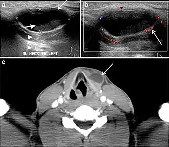 Fig. 19. Long-standing infected thyroglossal duct cyst in a 29-year-old male patient. a Transverse greyscale ultrasound at midline, just above the level of the thyroid gland, shows an oval cystic lesion with internal echoes (white arrows) and posterior enhancement (arrowheads). b Transverse colour Doppler ultrasound shows surrounding peripheral flow (white arrow). c Axial enhanced neck CT scan at the level of the thyroid cartilage demonstrates a slightly off-midline, well-defined, homogeneous cystic lesion embedded in the left strap muscle with peripheral enhancement (white arrow). It shows no calcification or internal enhancement. Thyroid gland was normal (not shown).